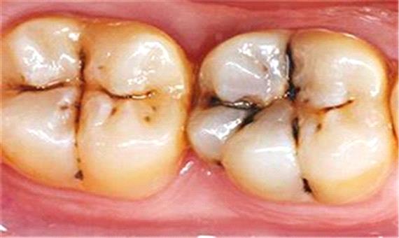 300 میلیون دندان پوسیده در دهان ایرانیان