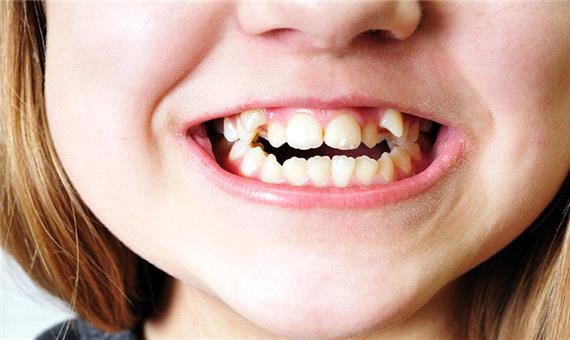 چرا دندان‌های بیشتر افراد نامرتب است؟